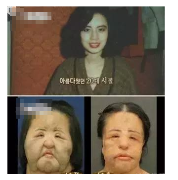 整容發(fā)生意外保險賠嗎？